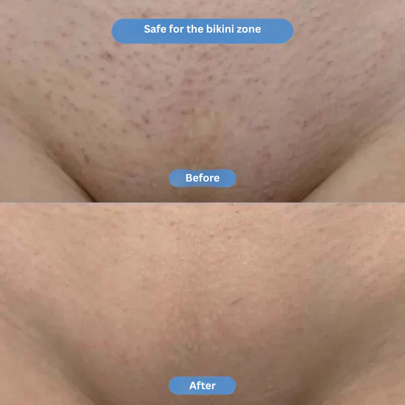 Purelle™ | Bright Bikini Line Serum