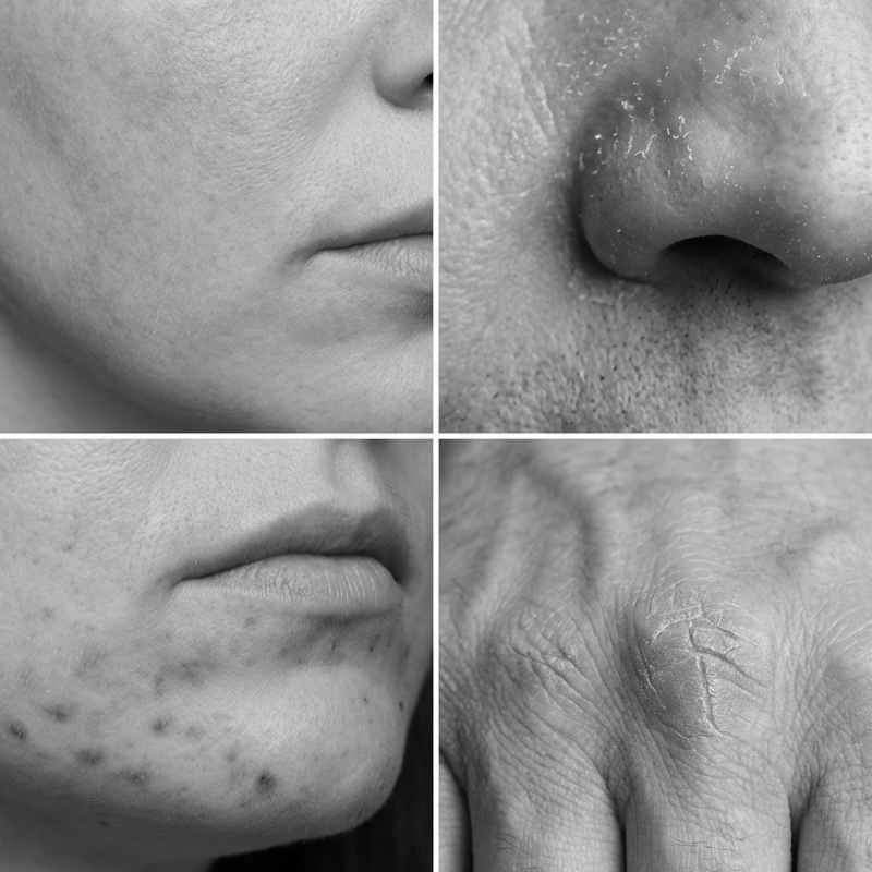 🔥 B5 Acne Repair Cream – Soothe & Clear Breakouts Fast